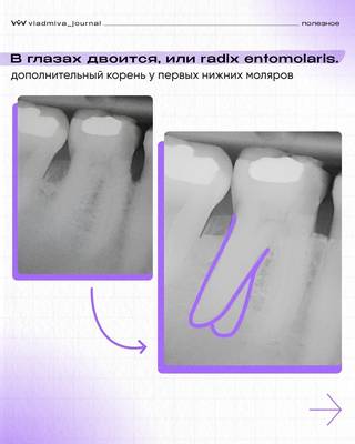 Radix Entomolaris — дистально-язычный корень нижних моляров.